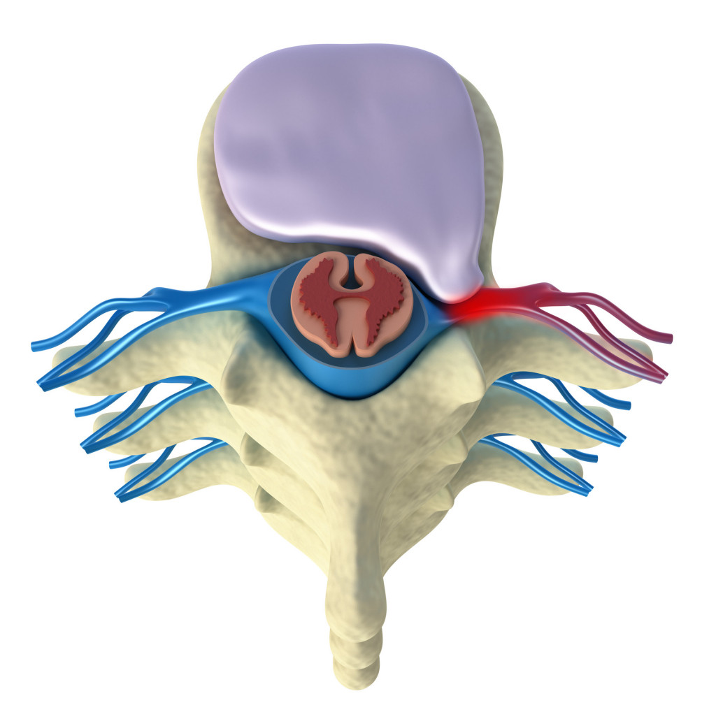 Fig 1 -Herniated disc